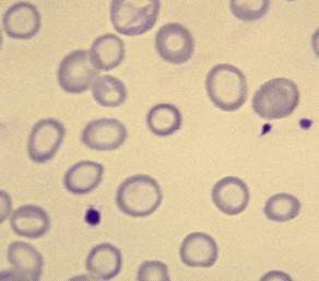 缺铁性贫血症