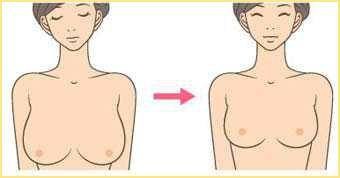 巨乳缩小手术