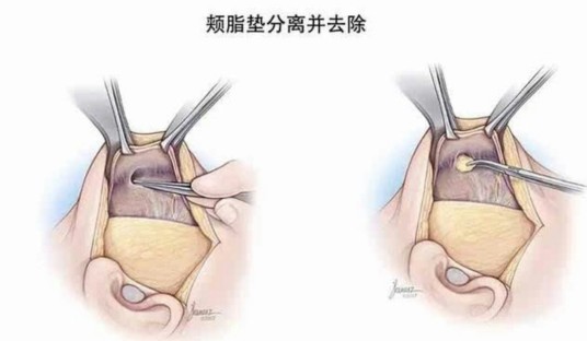 颊脂垫切除术