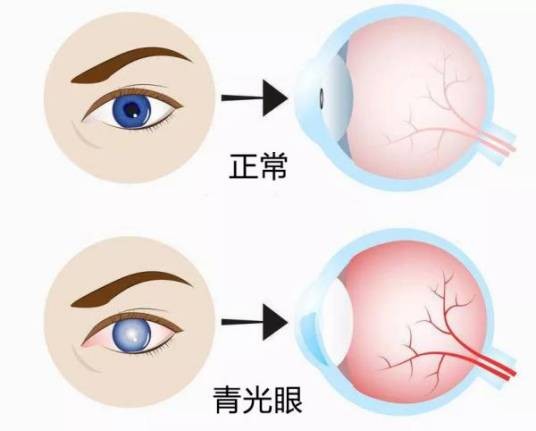 急性青光眼
