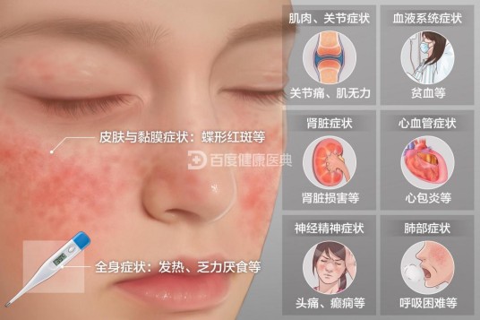 系统性红斑狼疮(疾病名)