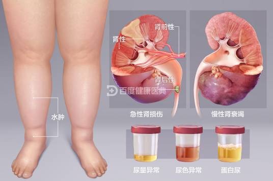 肾病(肾脏的各种疾病)