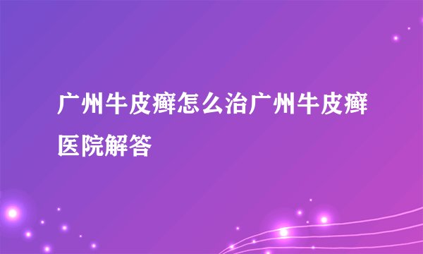 广州牛皮癣怎么治广州牛皮癣医院解答