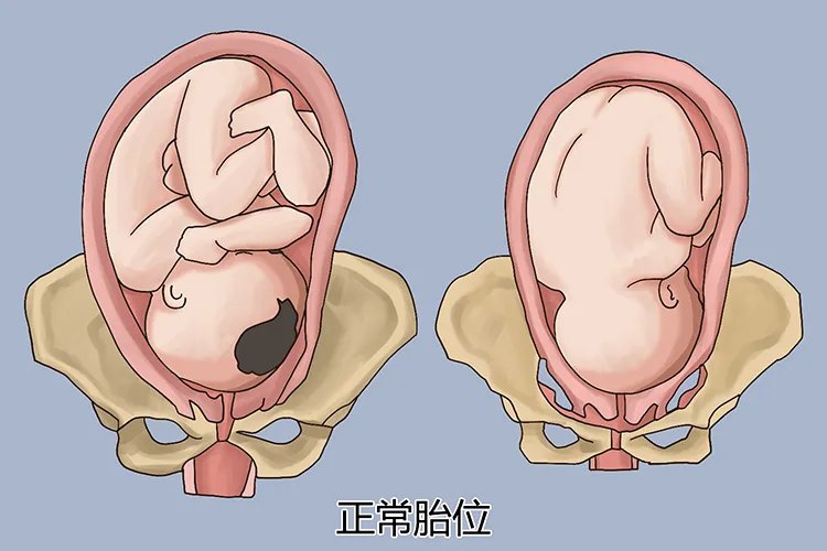 胎位图