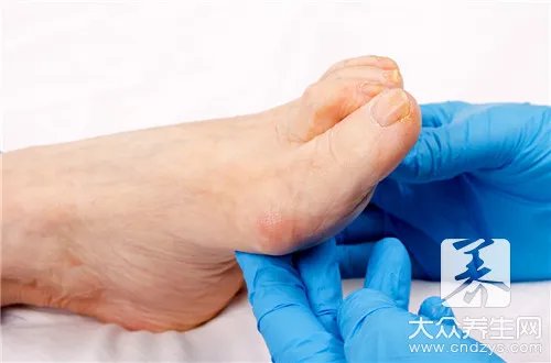 脚干燥起皮是什么原因怎么办