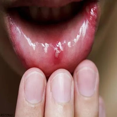 膜性口炎怎么治