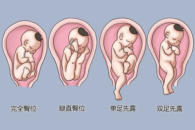 胎位图