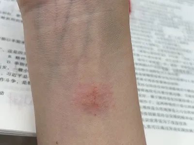 急性单纯性痒疹胳膊水疱图片