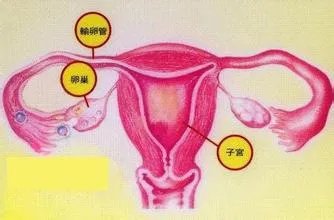 卵巢癌晚期