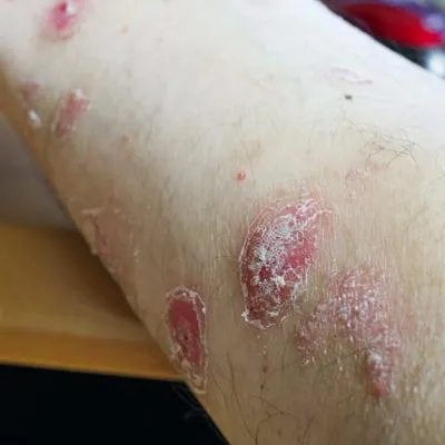 治疗牛皮癣有哪些好的药