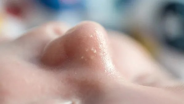 鼻子上毛孔粗大怎么办