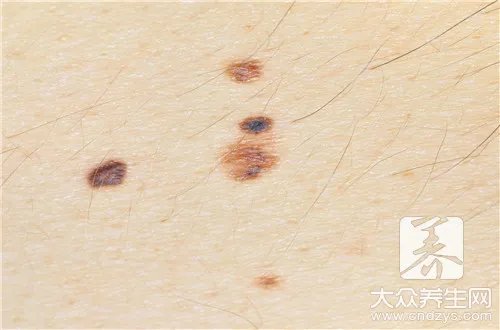 脸上痣的位置代表什么意思