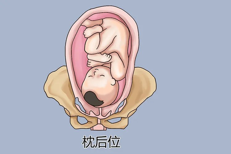 胎位图