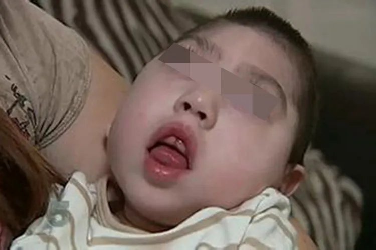 无脑婴儿图片