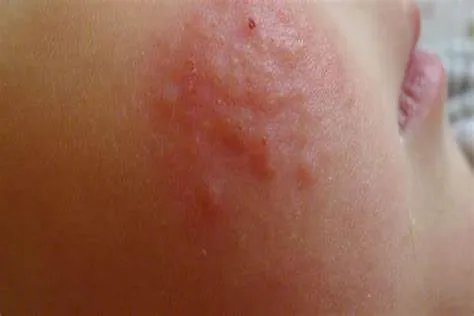 夏季皮炎湿疹图片