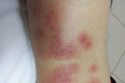 吸血臭虫咬后图片