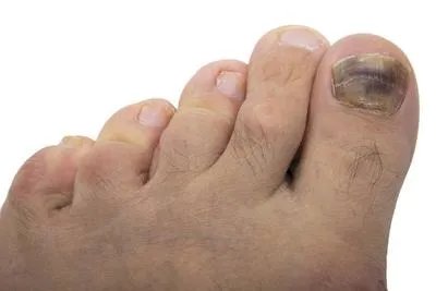 灰指甲中医治疗方法有哪些 详述灰指甲的三个中医方法