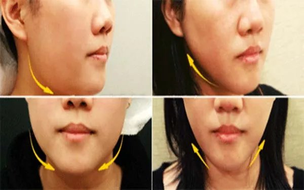 玻尿酸除皱医院是怎么收费的