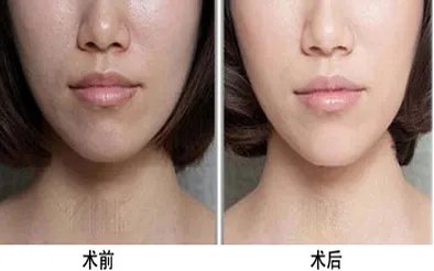 北京像束激光美白嫩肤效果怎么样