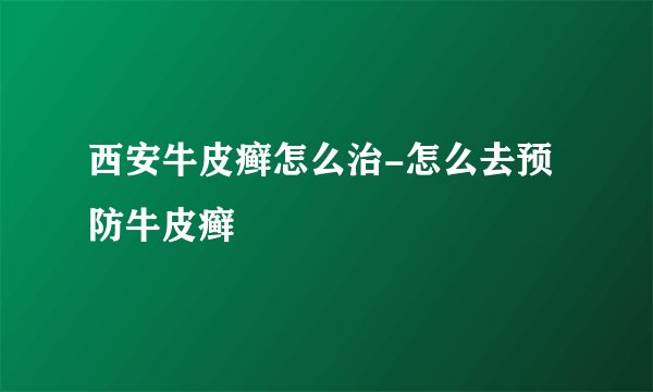 西安牛皮癣怎么治-怎么去预防牛皮癣