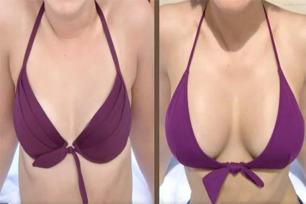 隆胸后的效果图