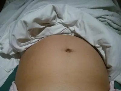 剖腹产刀疤增生应该怎么办