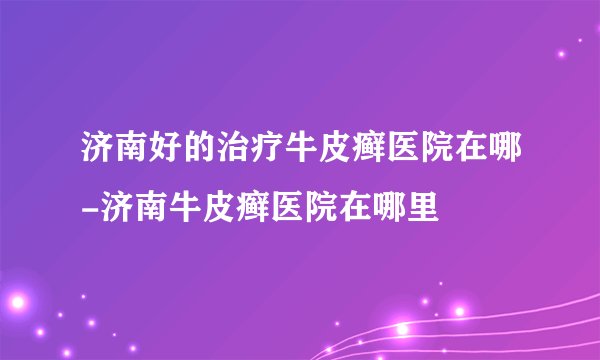 济南好的治疗牛皮癣医院在哪-济南牛皮癣医院在哪里