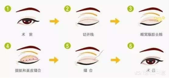 做双眼皮有几种方法?