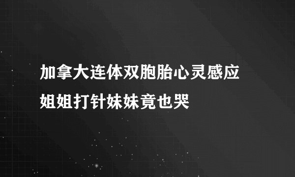加拿大连体双胞胎心灵感应 姐姐打针妹妹竟也哭