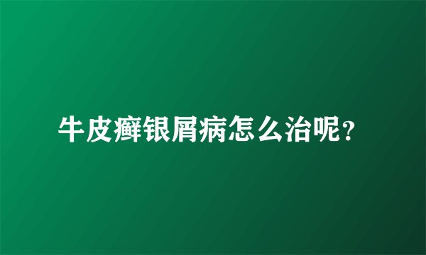 牛皮癣银屑病怎么治呢？