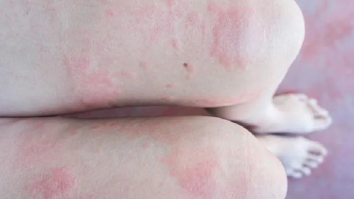 皮肤癌是怎么引起的
