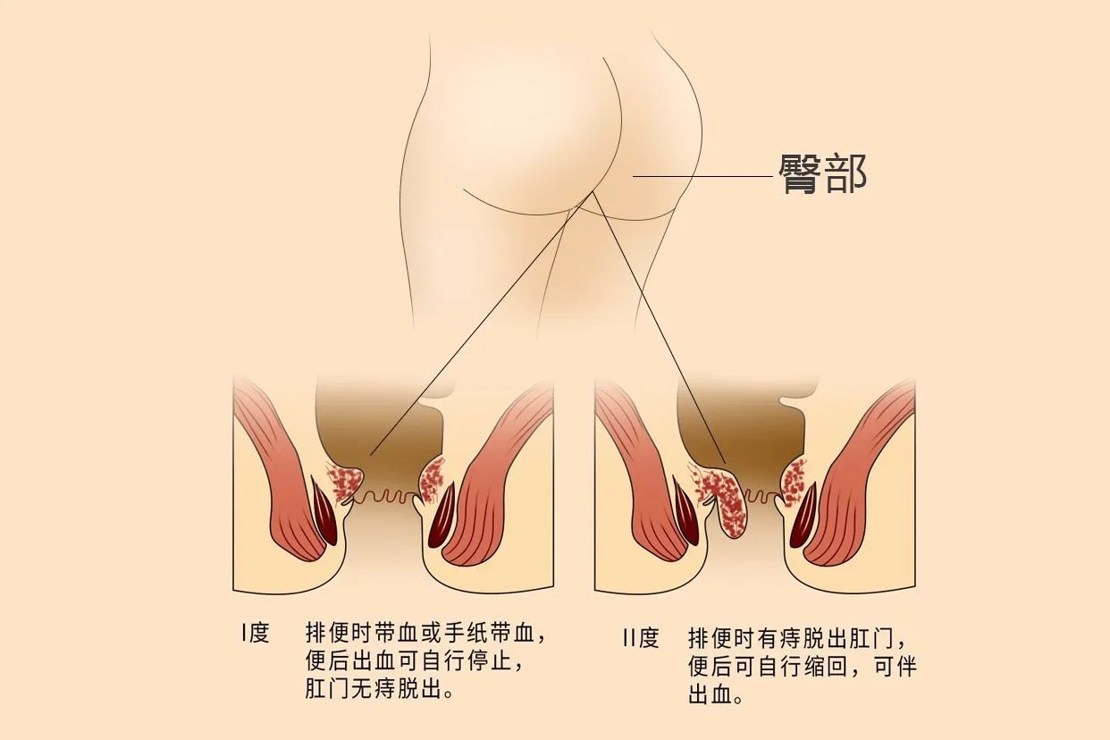 轻微痔疮图片