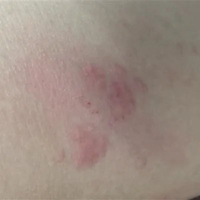 过敏怎么治疗
