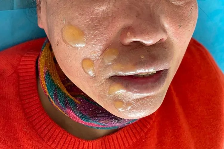烧伤图片