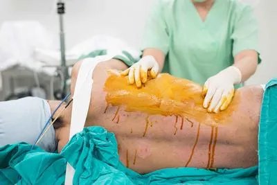 成人漏斗胸手术风险有哪些   如何减少成人漏斗胸的手术风险