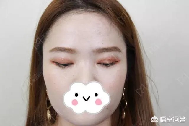 做双眼皮有几种方法?