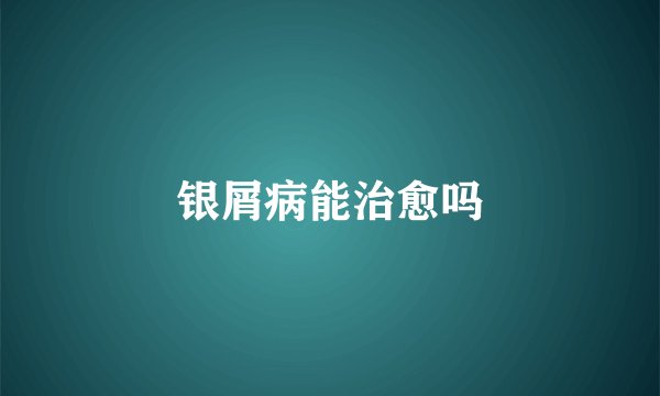 银屑病能治愈吗