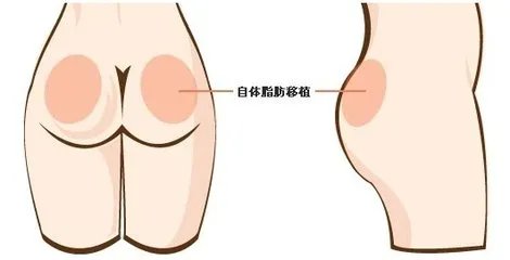 自体脂肪丰臀的效果怎么样