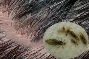 头上的虱子图片