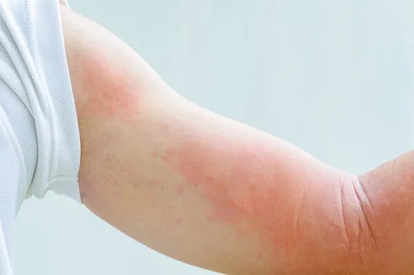 联邦抗敏胶囊治疗荨麻疹效果怎样？