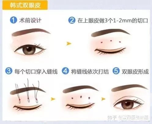 做双眼皮有几种方法?