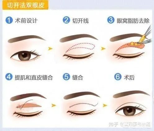 做双眼皮有几种方法?