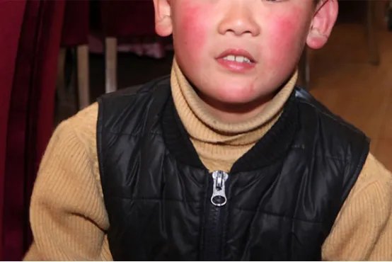 血热怎么调理