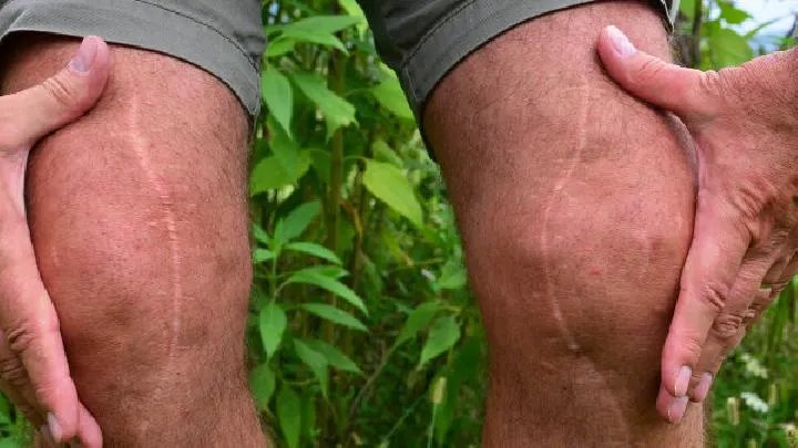 焦磷酸盐结晶性关节炎需要做哪些化验检查